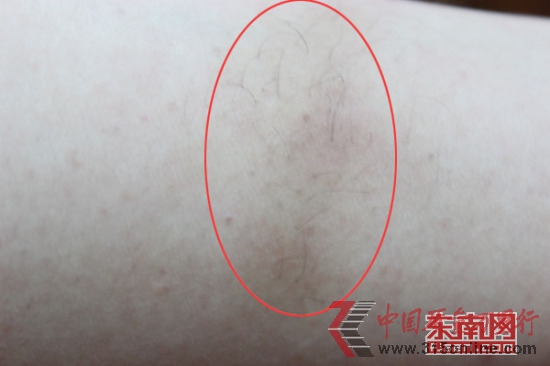 林小姐使用云南白藥氣霧劑后,長(zhǎng)出1厘米黑毛 林小姐使用云南白藥氣霧劑后,長(zhǎng)出1厘米黑毛